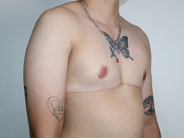 Female to Male Before & After Gallery - Patient 406813 - Image 2