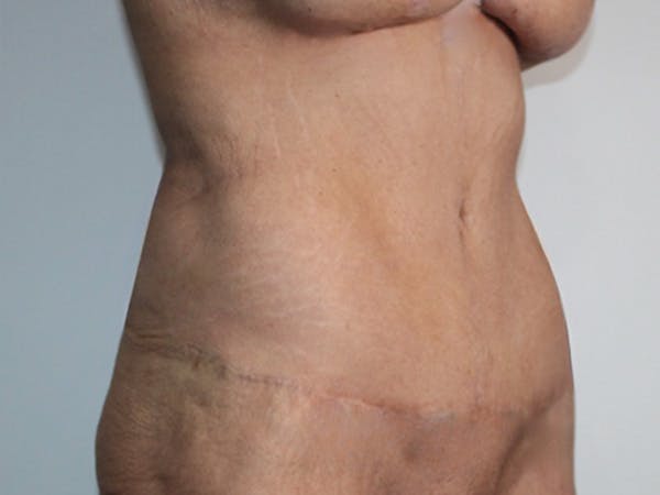 Tummy Tuck Before & After Gallery - Patient 325787 - Image 2