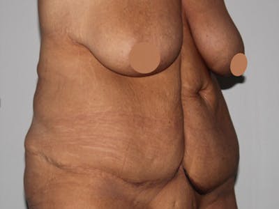 Tummy Tuck Before & After Gallery - Patient 325787 - Image 1