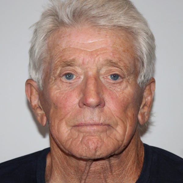 Croton Oil Peel Before & After Gallery - Patient 369393 - Image 1
