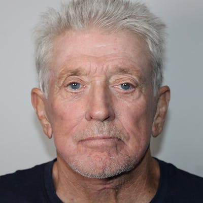 Croton Oil Peel Before & After Gallery - Patient 369393 - Image 2