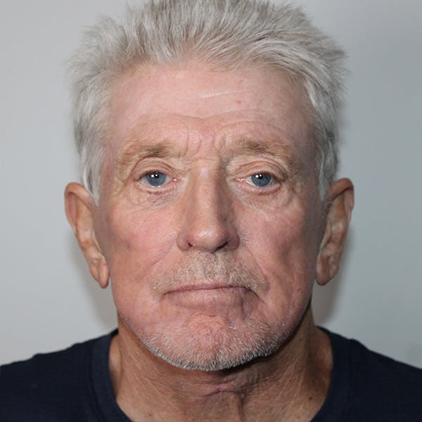 Croton Oil Peel Before & After Gallery - Patient 369393 - Image 2