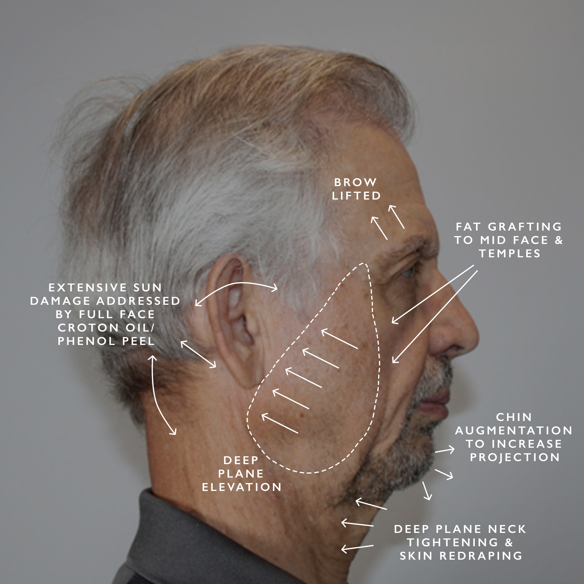 before facelift surgery