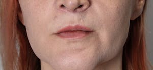 Before and After Lip Lift