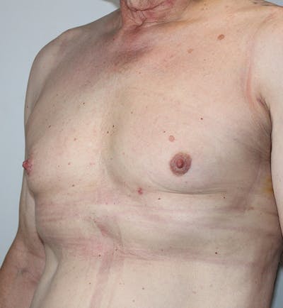 Renuvion Before & After Gallery - Patient 200590 - Image 2