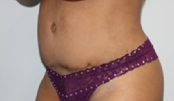 Tummy Tuck Before & After Gallery - Patient 412884 - Image 3