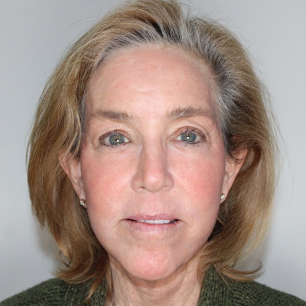 Facelift Before & After Gallery - Patient 646276 - Image 2