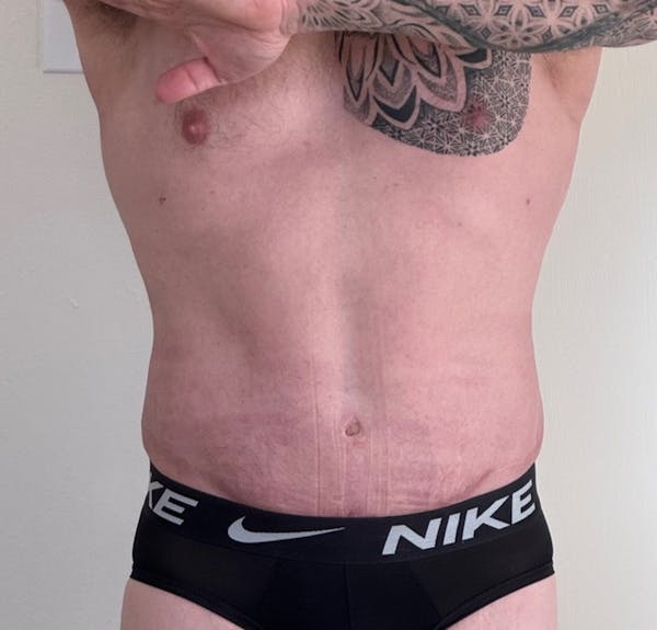 Liposuction For Men Before & After Gallery - Patient 330756 - Image 2