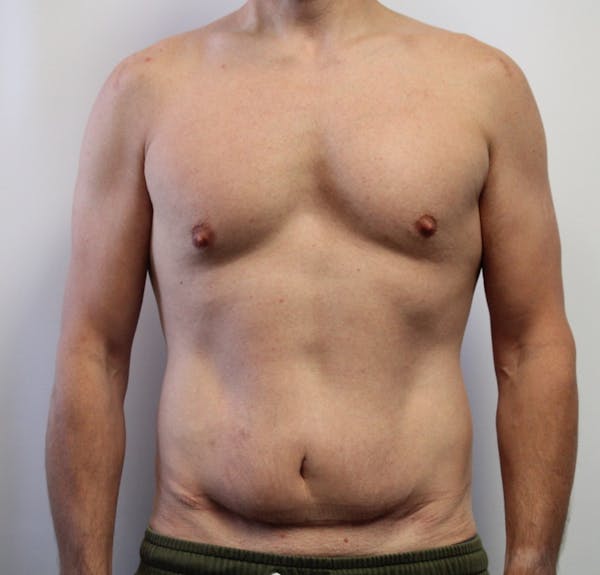 Liposuction For Men Before & After Gallery - Patient 330756 - Image 1