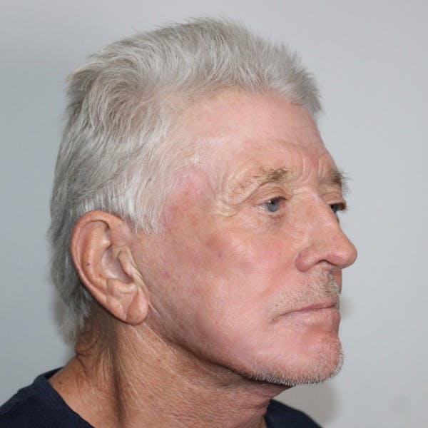 Facelift Before & After Gallery - Patient 207076 - Image 2