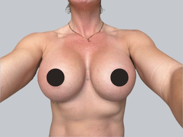 Breast Augmentation Before & After Gallery - Patient 427436 - Image 2