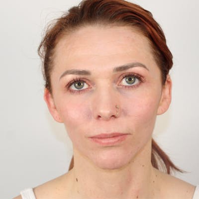 Croton Oil Peel Before & After Gallery - Patient 206752 - Image 2