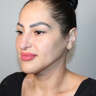 Neck Lift Before & After Gallery - Patient 279408 - Image 2