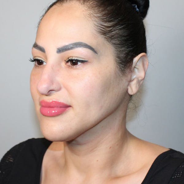 Neck Lift Before & After Gallery - Patient 279408 - Image 2