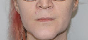 Before and After Lip Lift