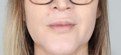Lip Lift Before & After Gallery - Patient 337099 - Image 2
