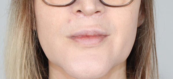 Lip Lift Before & After Gallery - Patient 337099 - Image 2