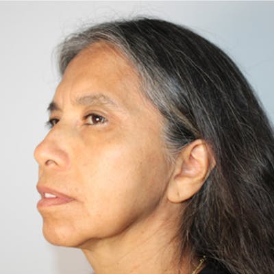 Croton Oil Peel Before & After Gallery - Patient 187110 - Image 1