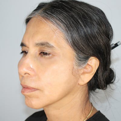 Croton Oil Peel Before & After Gallery - Patient 187110 - Image 2