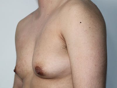 Female to Male Before & After Gallery - Patient 182553 - Image 1