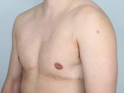 Female to Male Before & After Gallery - Patient 182553 - Image 2