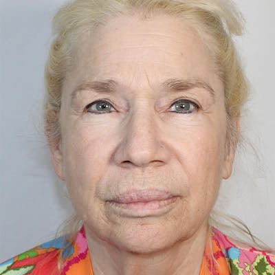 Facelift Before & After Gallery - Patient 373288 - Image 1