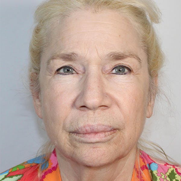 Facelift Before & After Gallery - Patient 373288 - Image 1