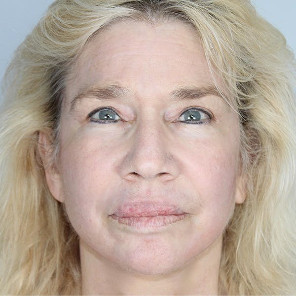 Facelift Before & After Gallery - Patient 373288 - Image 2