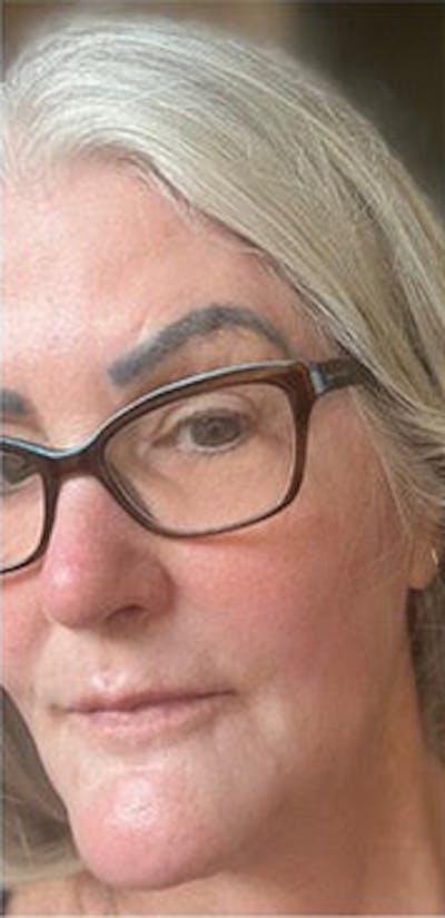 Facelift Before & After Gallery - Patient 956075 - Image 2
