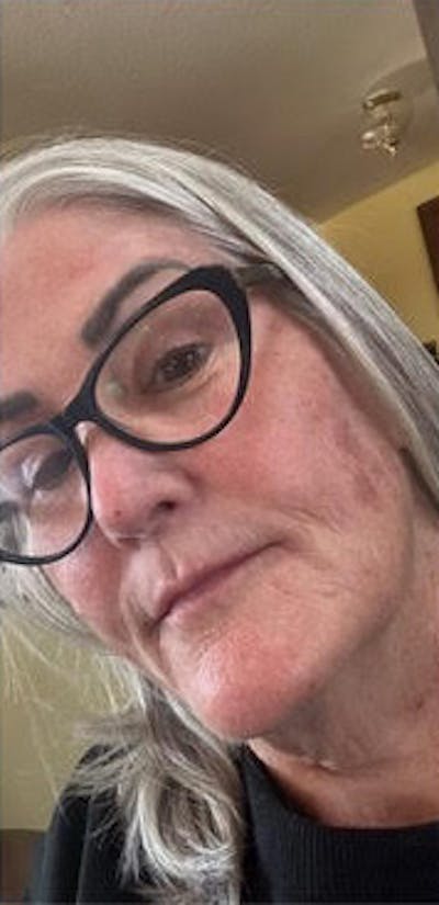 Facelift Before & After Gallery - Patient 956075 - Image 1