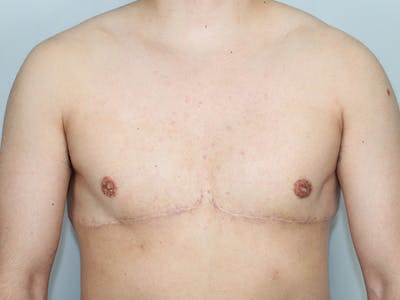 Female to Male Before & After Gallery - Patient 238144 - Image 2