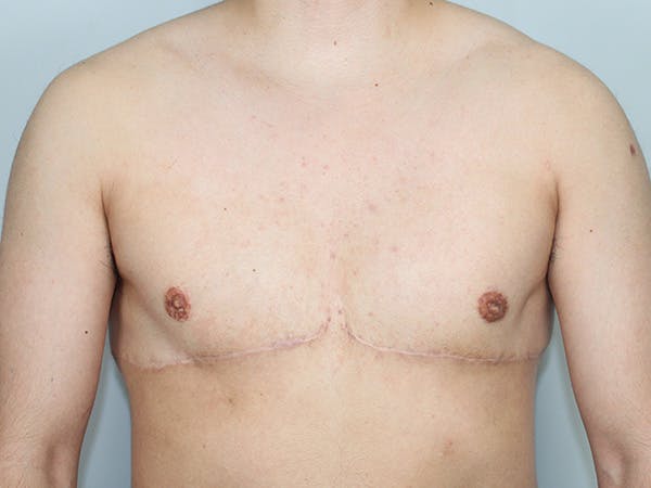 Female to Male Before & After Gallery - Patient 238144 - Image 2