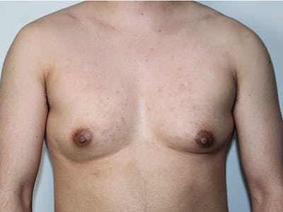 Female to Male Before & After Gallery - Patient 238144 - Image 1