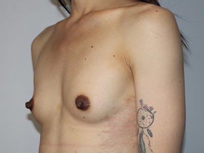 Breast Augmentation Before & After Gallery - Patient 695417 - Image 1