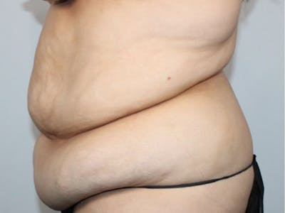 Liposuction Before & After Gallery - Patient 426204 - Image 1