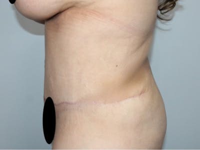 Liposuction Before & After Gallery - Patient 426204 - Image 2