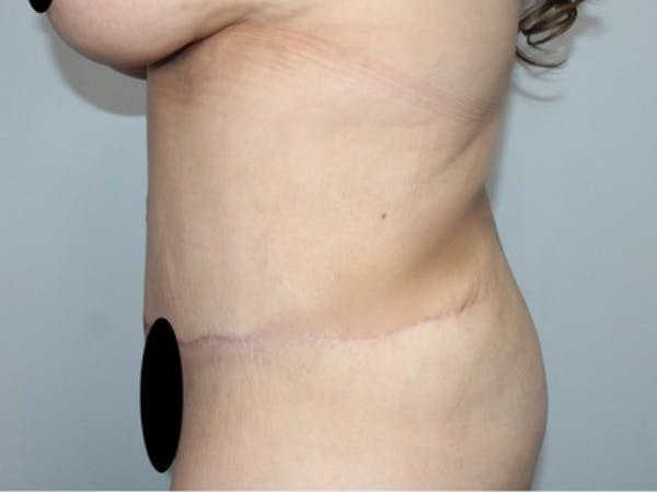 Liposuction Before & After Gallery - Patient 426204 - Image 2