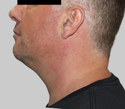 Dermal Fillers Before & After Gallery - Patient 110568 - Image 1