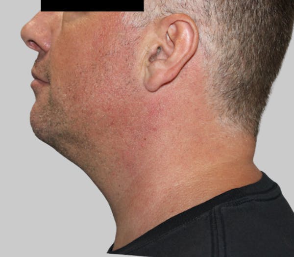 Dermal Fillers Before & After Gallery - Patient 110568 - Image 1