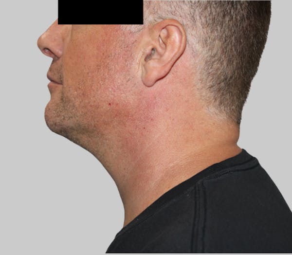 Dermal Fillers Before & After Gallery - Patient 110568 - Image 2
