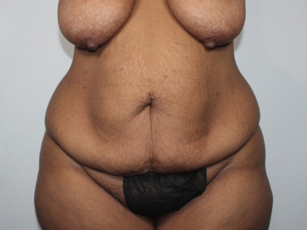 Tummy Tuck Before & After Gallery - Patient 206878 - Image 1