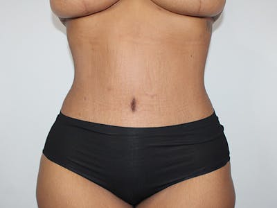 Tummy Tuck Before & After Gallery - Patient 206878 - Image 2