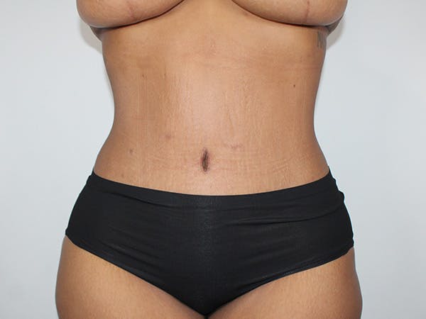 Tummy Tuck Before & After Gallery - Patient 206878 - Image 2