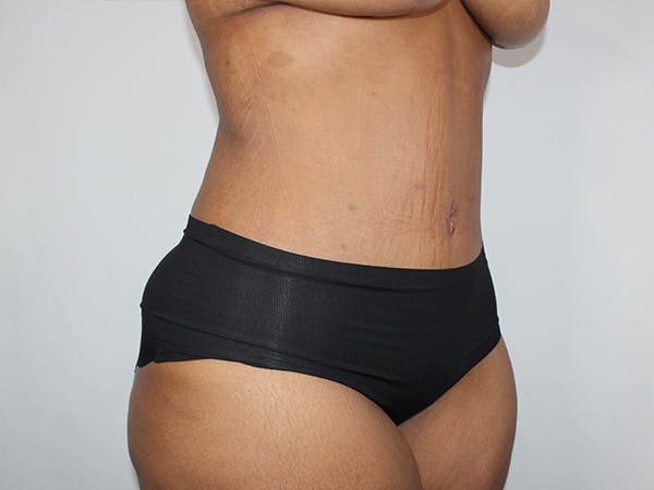 Tummy Tuck Before & After Gallery - Patient 206878 - Image 4