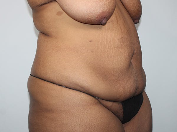 Tummy Tuck Before & After Gallery - Patient 206878 - Image 3