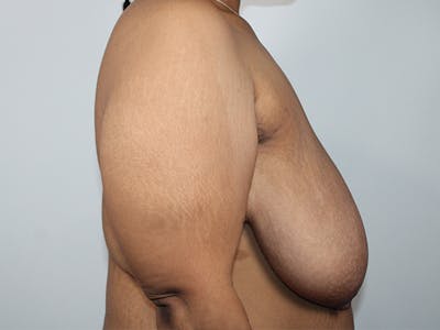 Breast Lift Before & After Gallery - Patient 224225 - Image 1