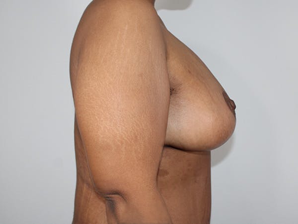 Breast Lift Before & After Gallery - Patient 224225 - Image 2
