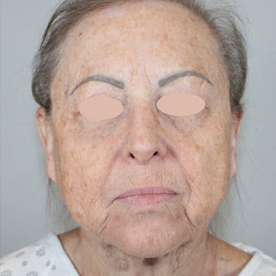Croton Oil Peel Before & After Gallery - Patient 417755 - Image 1