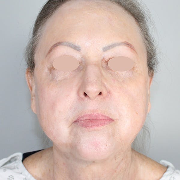 Croton Oil Peel Before & After Gallery - Patient 417755 - Image 2