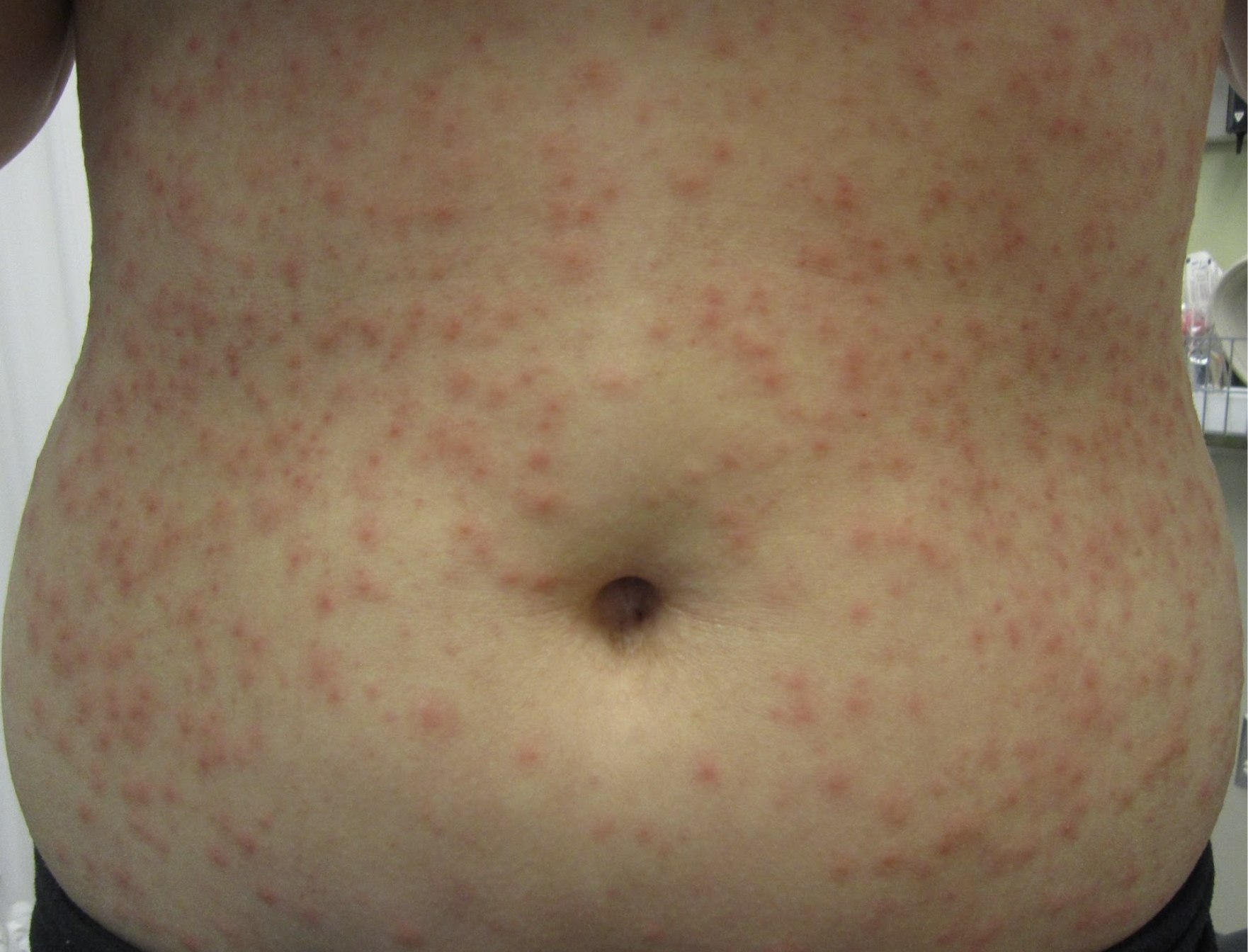 spa pool folliculitis